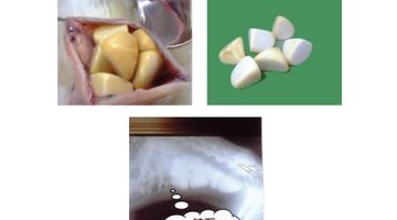 膀胱結石摘出手術