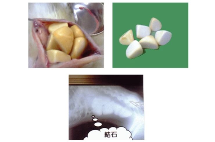 膀胱結石摘出手術
