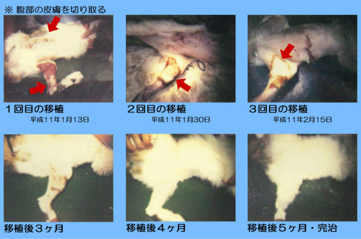 皮膚移植術